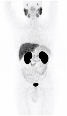 Normal Variants, Pitfalls, and Artifacts in Ga-68 Prostate Specific Membrane Antigen (PSMA) PET/CT Imaging